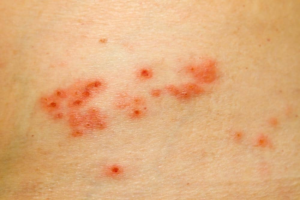 Skin rash caused by ear mites